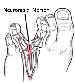 neuroma-di-morton