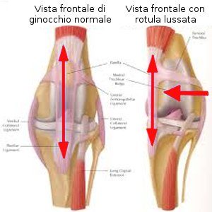 Lussazione di rotula