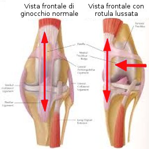 Lussazione di rotula