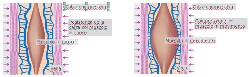 Insufficienza venosa e uso delle calze elastiche